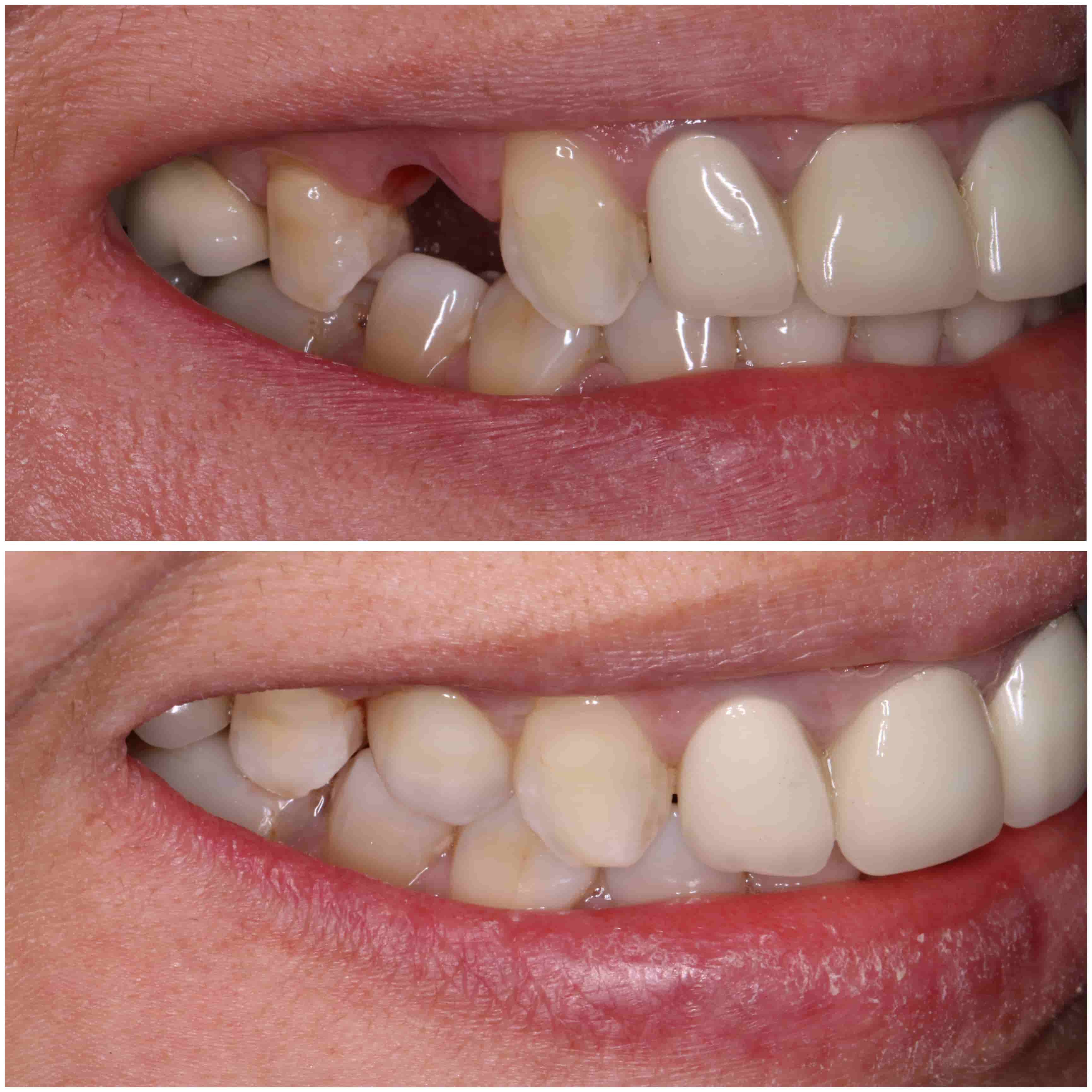 Risultato impianto dentale multiplo — Bios Center Osimo